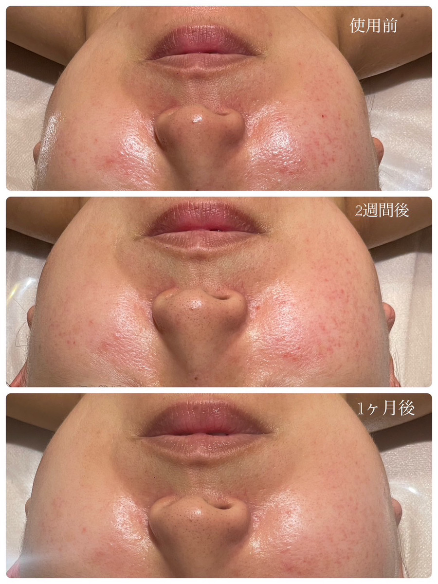 Vianne使用者の肌の様子